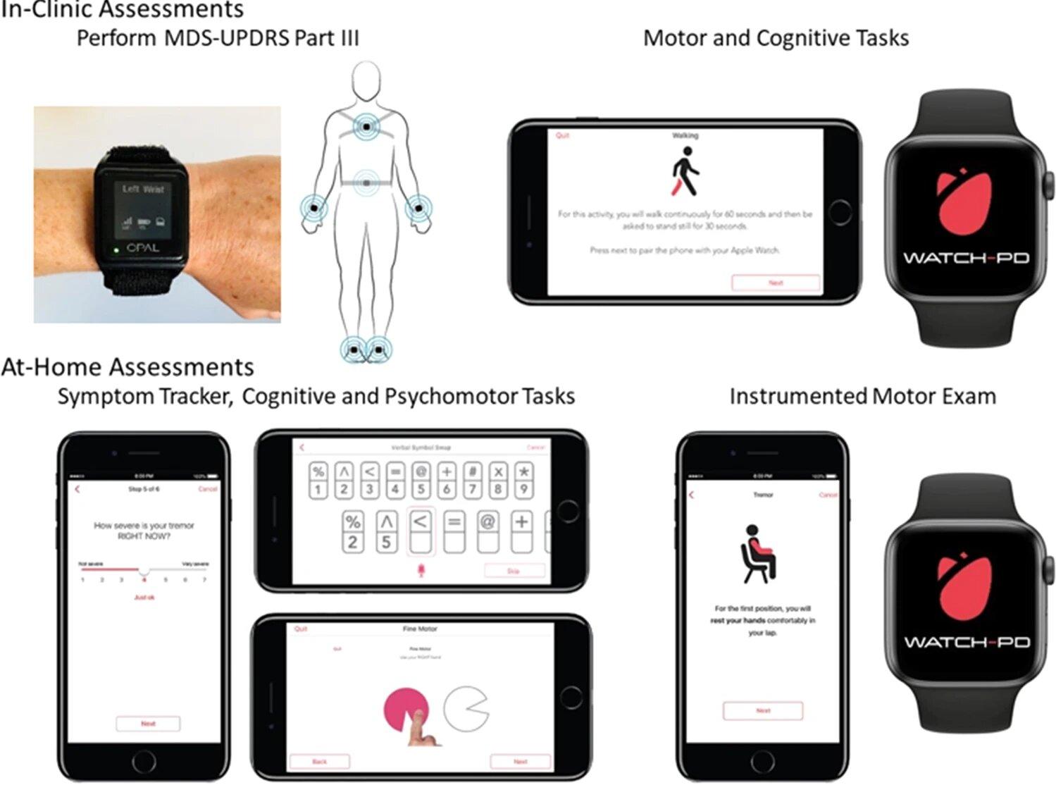 Smartwatches may be key to development of new Parkinson’s treatments