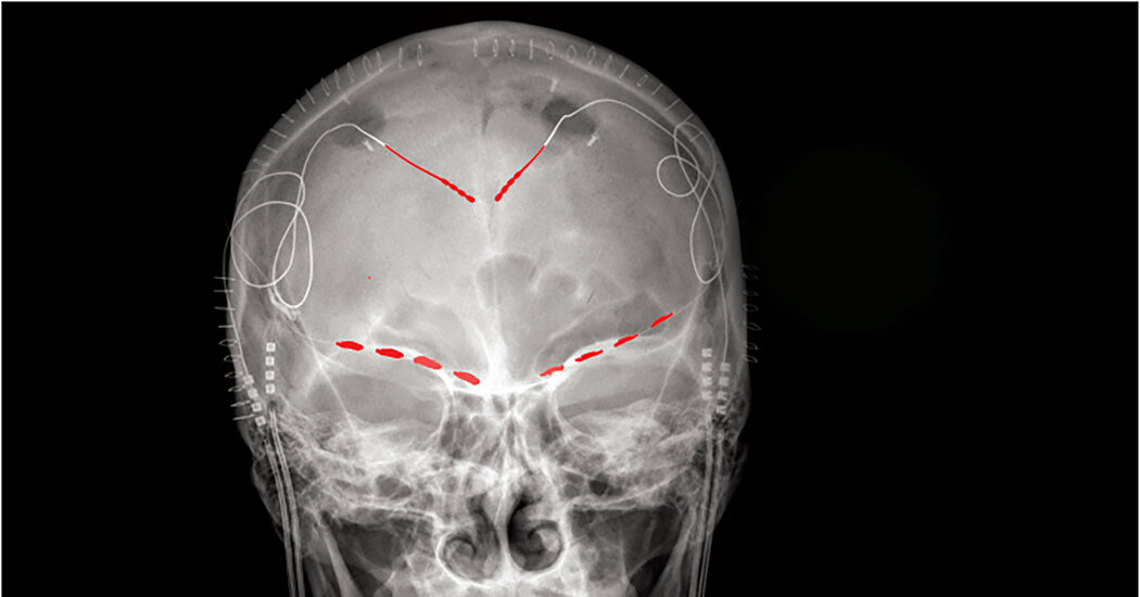 Long-term Suffering Connected to Brain Signals in Orbitofrontal Cortex