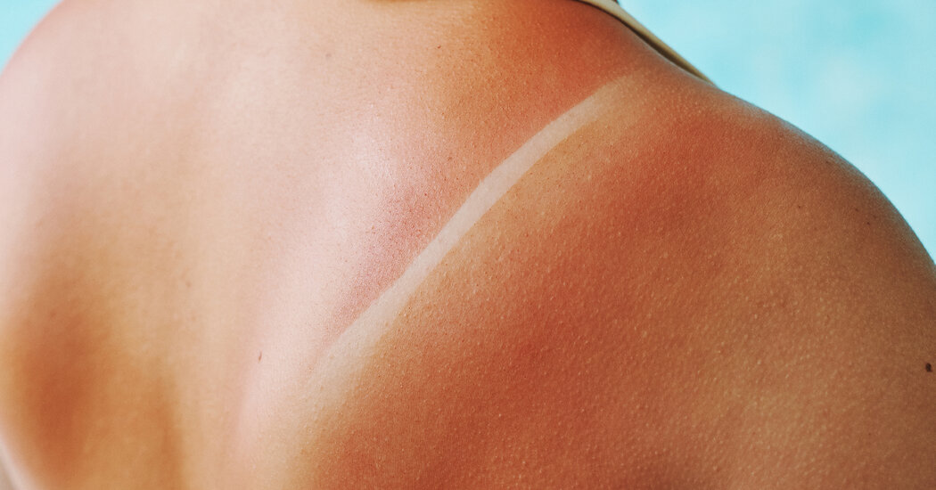 How to Treat a Poor Sunburn