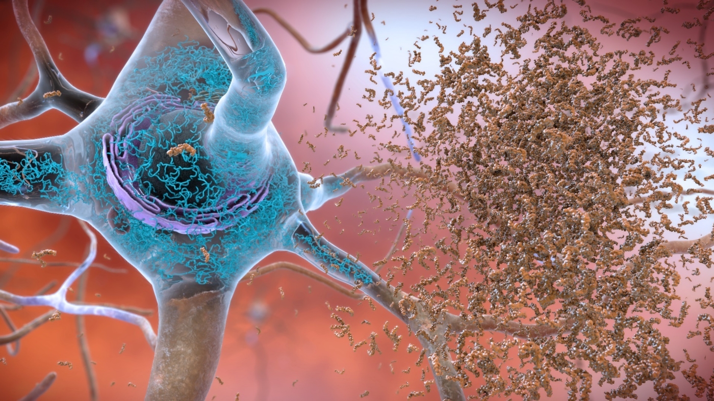 Alzheimer’s drug lecanemab may soon get full FDA approval. Who will get access? : Shots