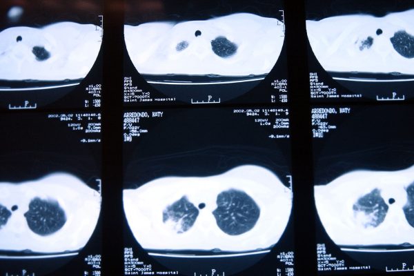 Tacoma woman in custody after refusing tuberculosis treatment for over 14 months : NPR