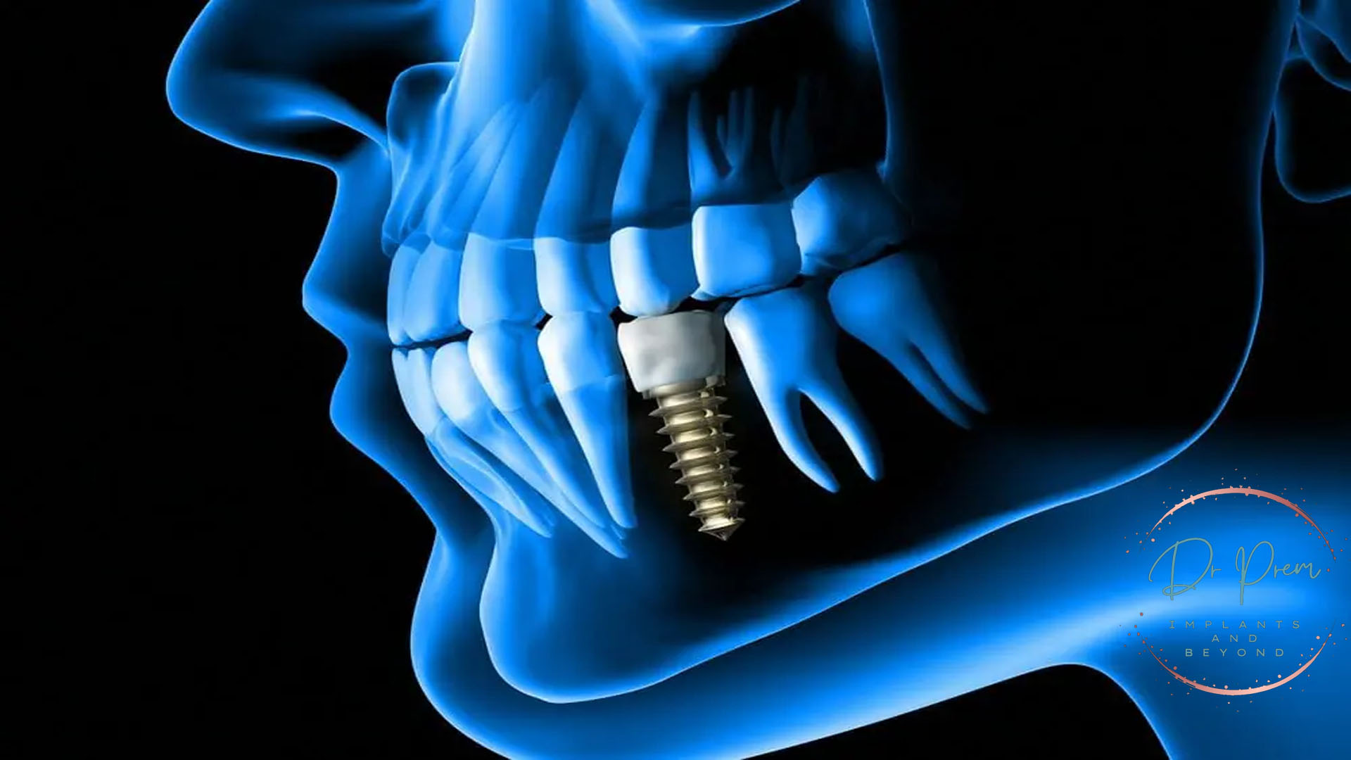 Full Mouth Dental Implants vs. Dentures: Making an Informed Choice (DOCTORPREM)