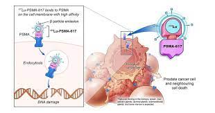 LUTETIUM-177 PSMA THERAPY FOR PROSTATE CANCER