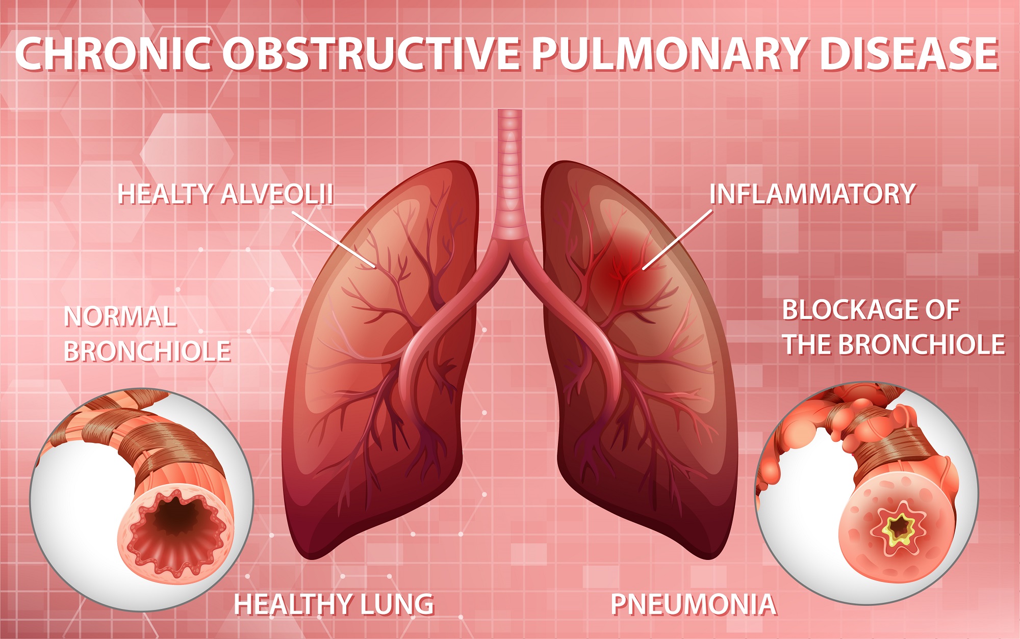 Changing Reimbursement Policies Bound to Push the Chronic Obstructive Pulmonary Disease Market Share