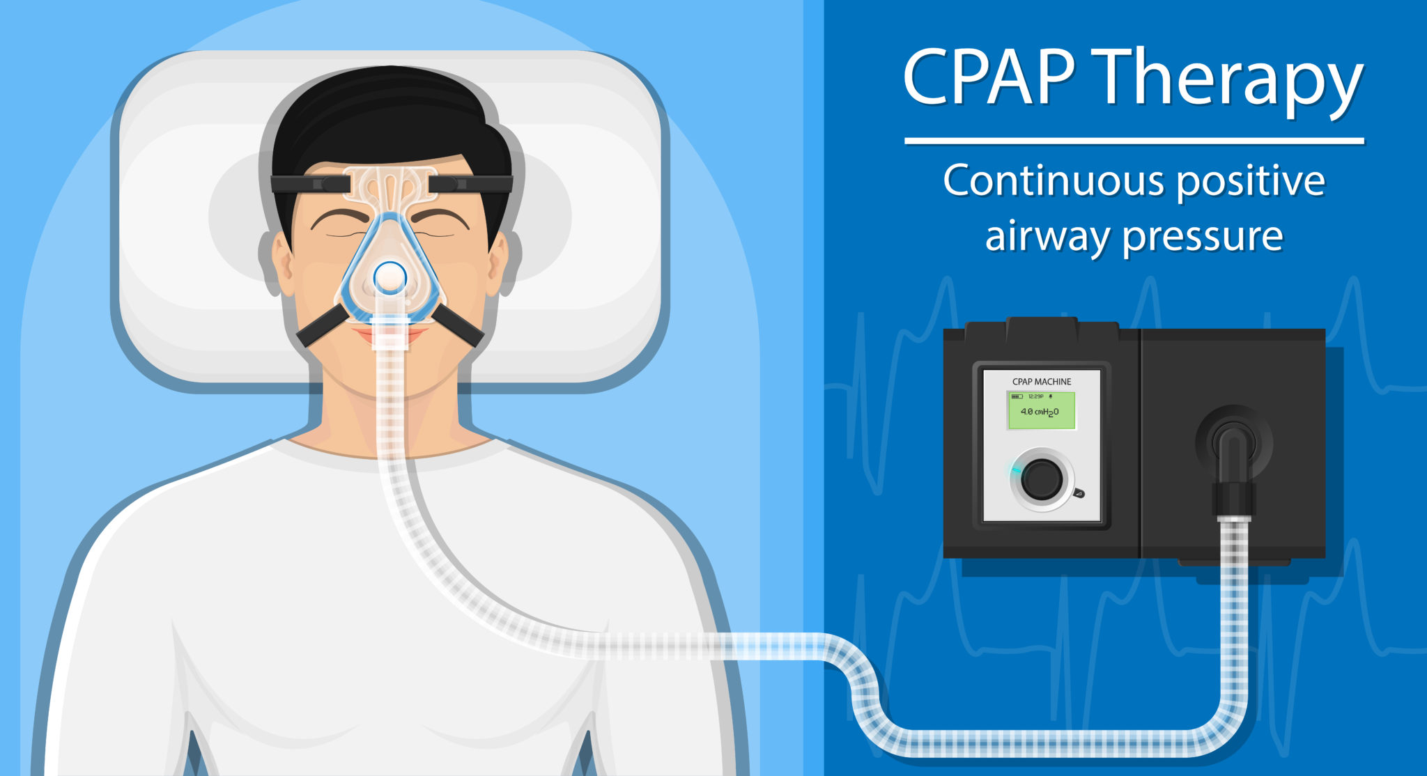 Global Continuous Positive Airway Pressure Devices Market Share Poised to Witness a Strong Growth over 2030