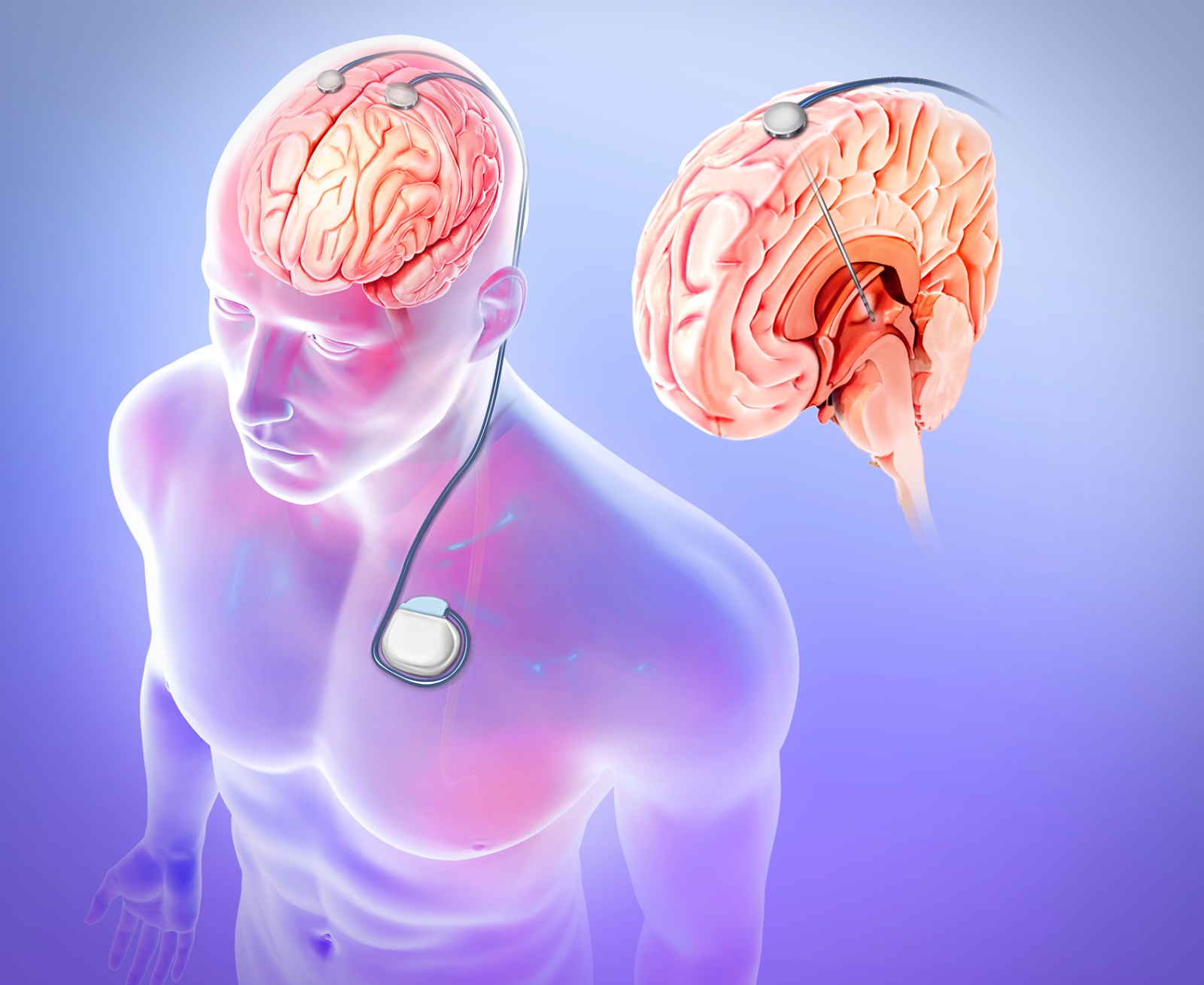 Global Epilepsy Surgery Market Trends on the Basis of Types, End-Users, and Region Segmentation