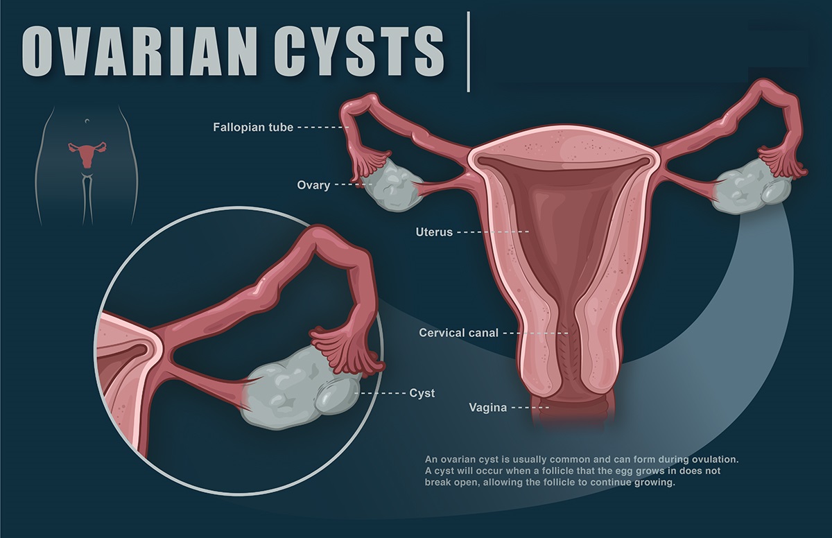 Global Ovarian Cysts Market Share Prognosticated To Perceive A Thriving Growth; MRFR Unleashes Industry Insights