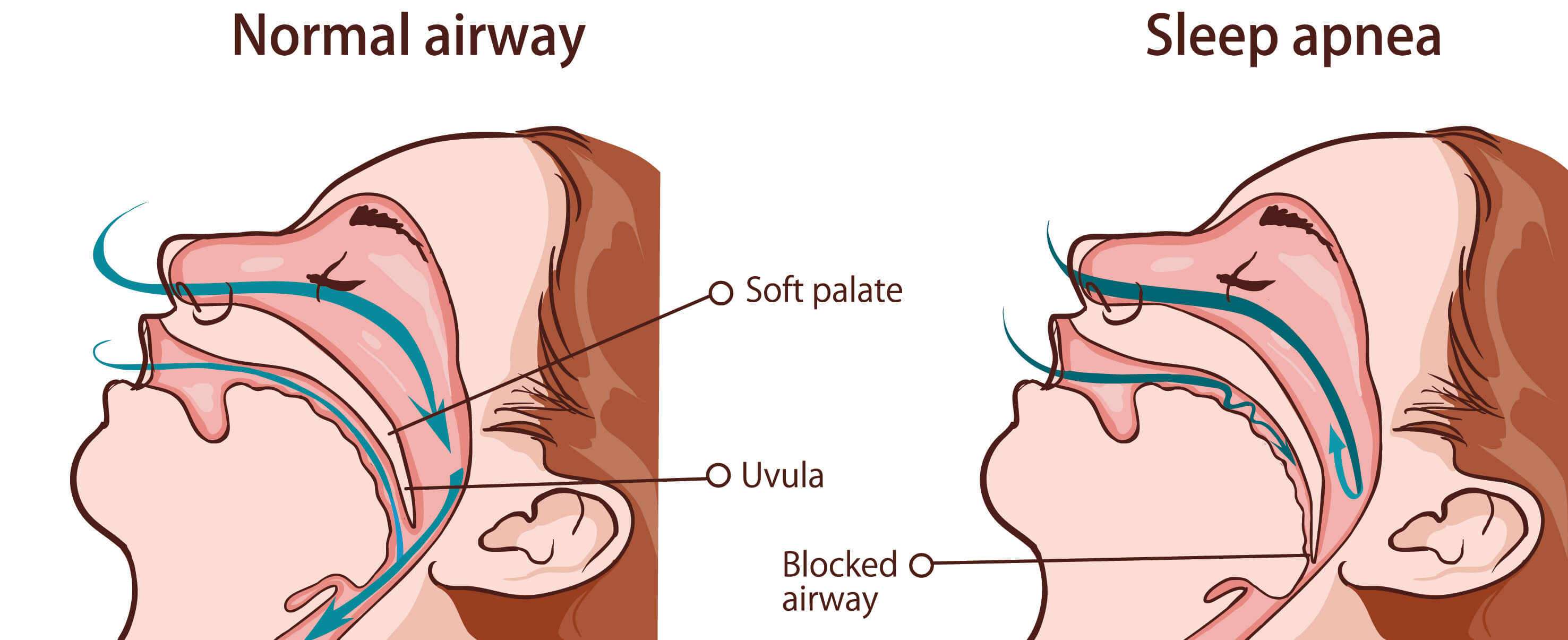 Global Sleep Apnea Device Market Share Emergence, Insights on Industry Size