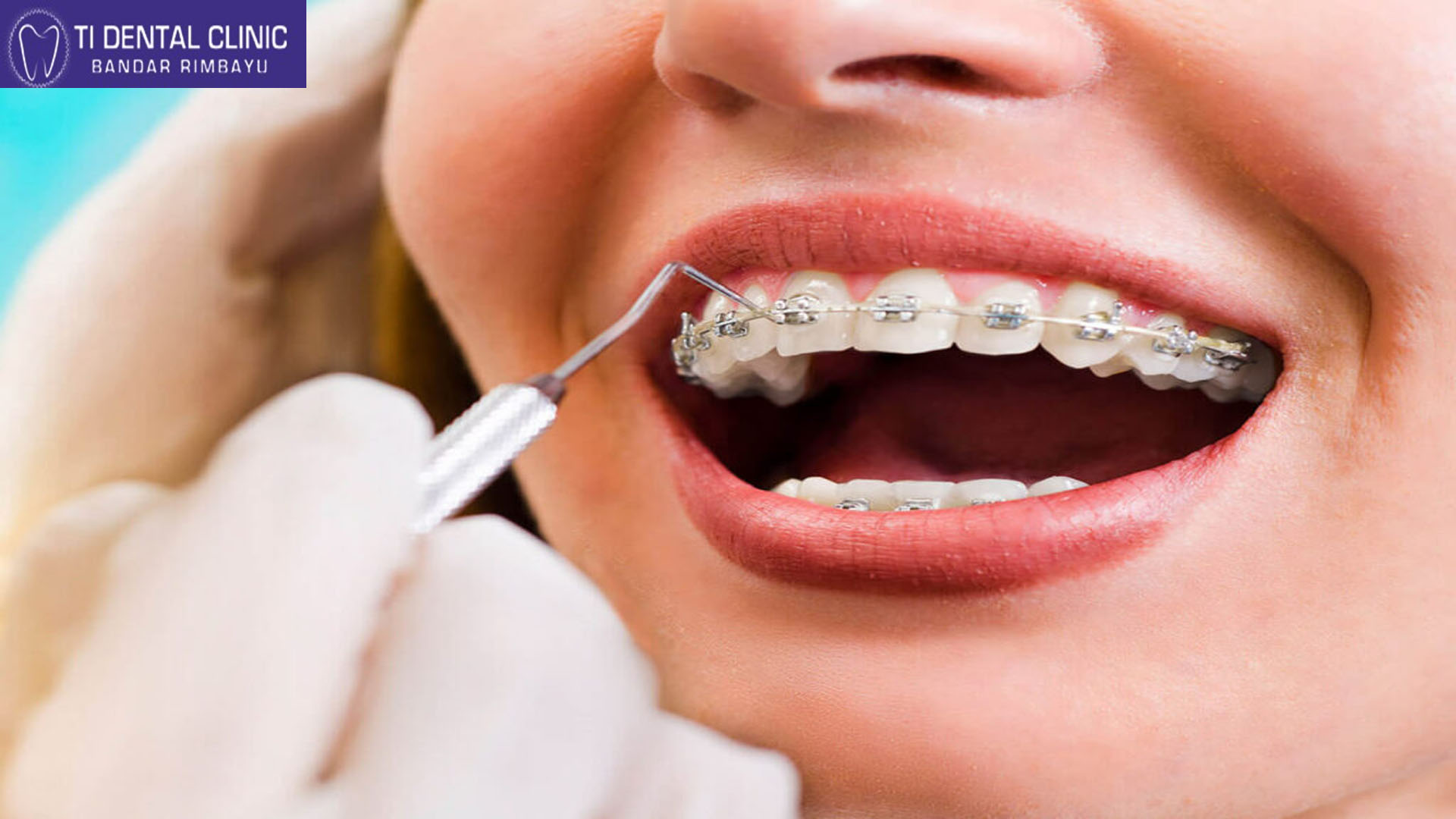 Dental Braces: Beyond Aesthetics, Promoting Oral Health (Tidental)