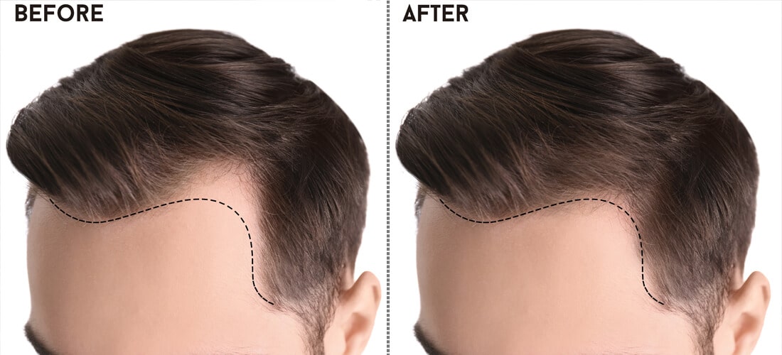 Unlocking Excellence: Your Ultimate Guide to Finding the Best Hair Transplant in Islamabad