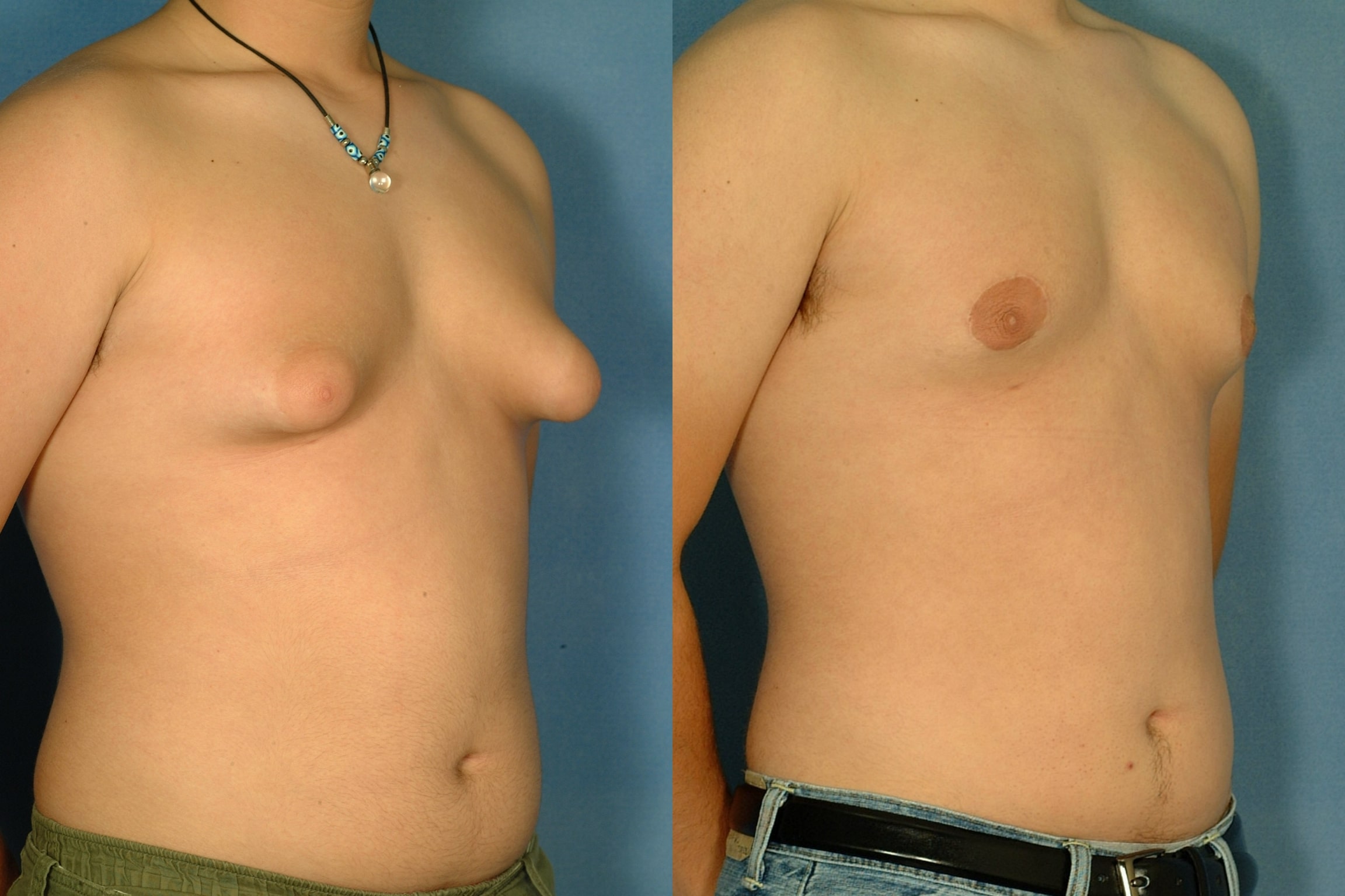 Gynecomastia Surgery: Addressing Common Concerns and FAQs