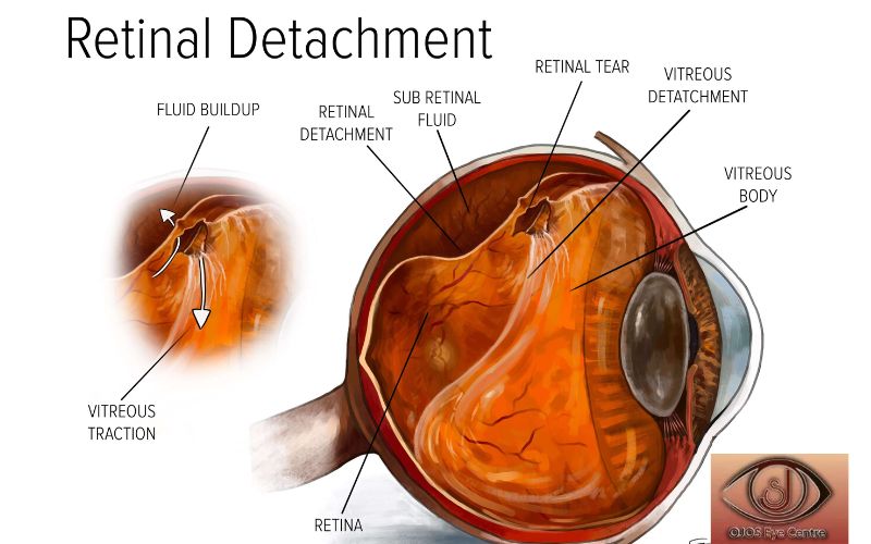 Protecting Your Eyesight: How to Reduce Your Risk of Retinal Detachment