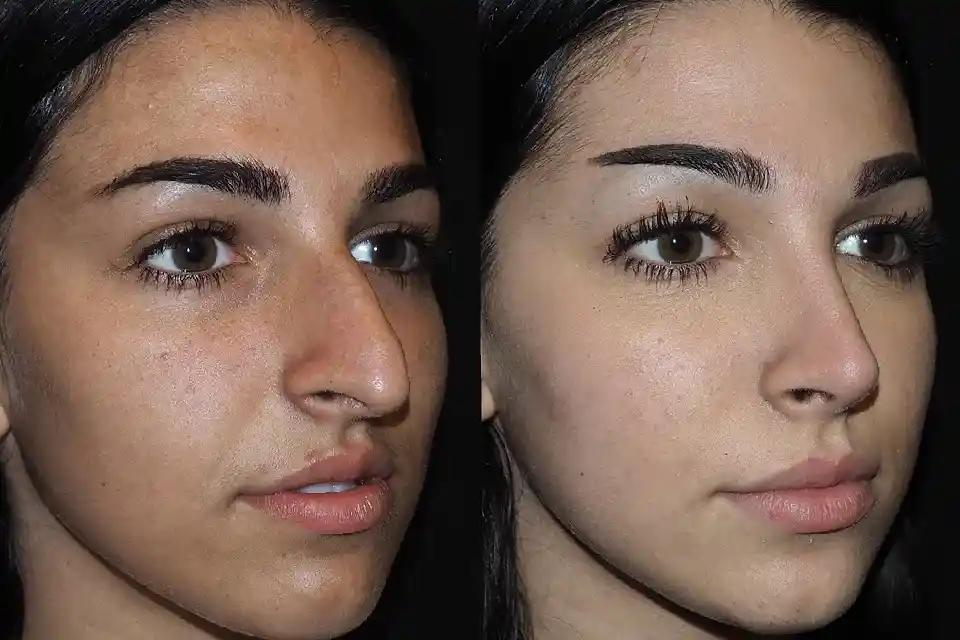 Before and After Rhinoplasty Stories from Dubai