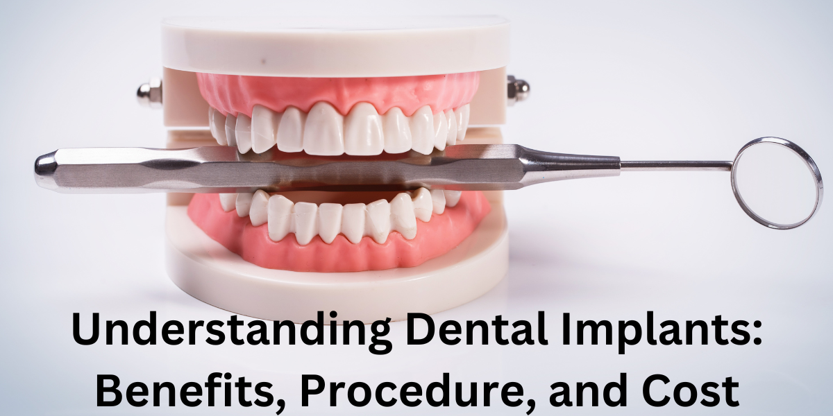 The Future of Smile Restoration: Exploring the Advantages of Dental Implants