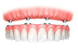 Carolina Dentist Insights: Affordable Denture Options Explained