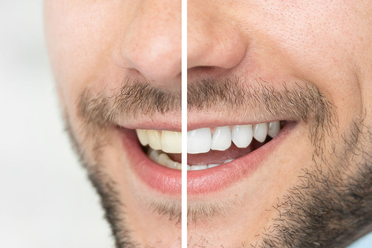 How Invisalign and Teeth Whitening Work Together